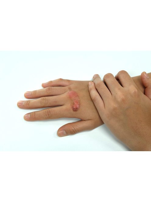 Abilar ® 10% sebbalzsam   3+1 AKCIÓ